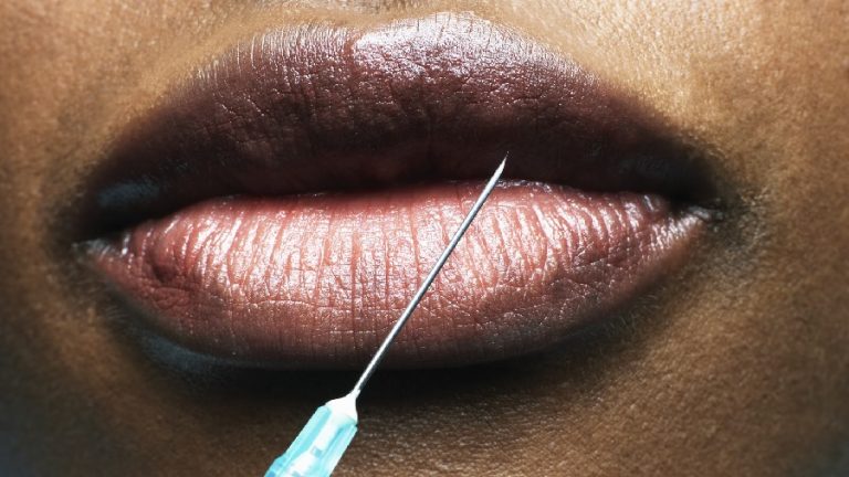 New Lip Reduction Surgery Procedure Gaining Popularity